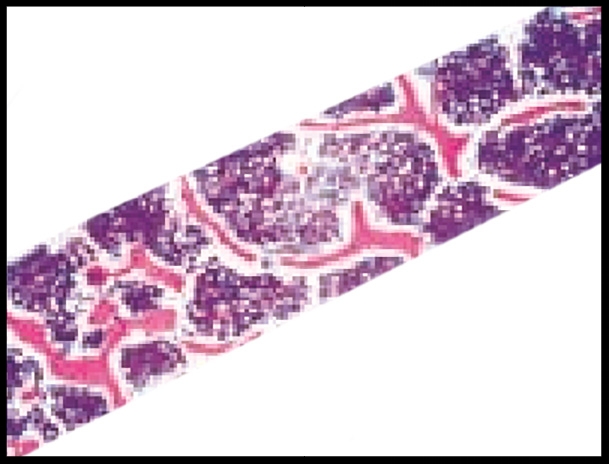 Under microscopic examination, the cancellous bone dowel’s micro-vascular network can be seen.