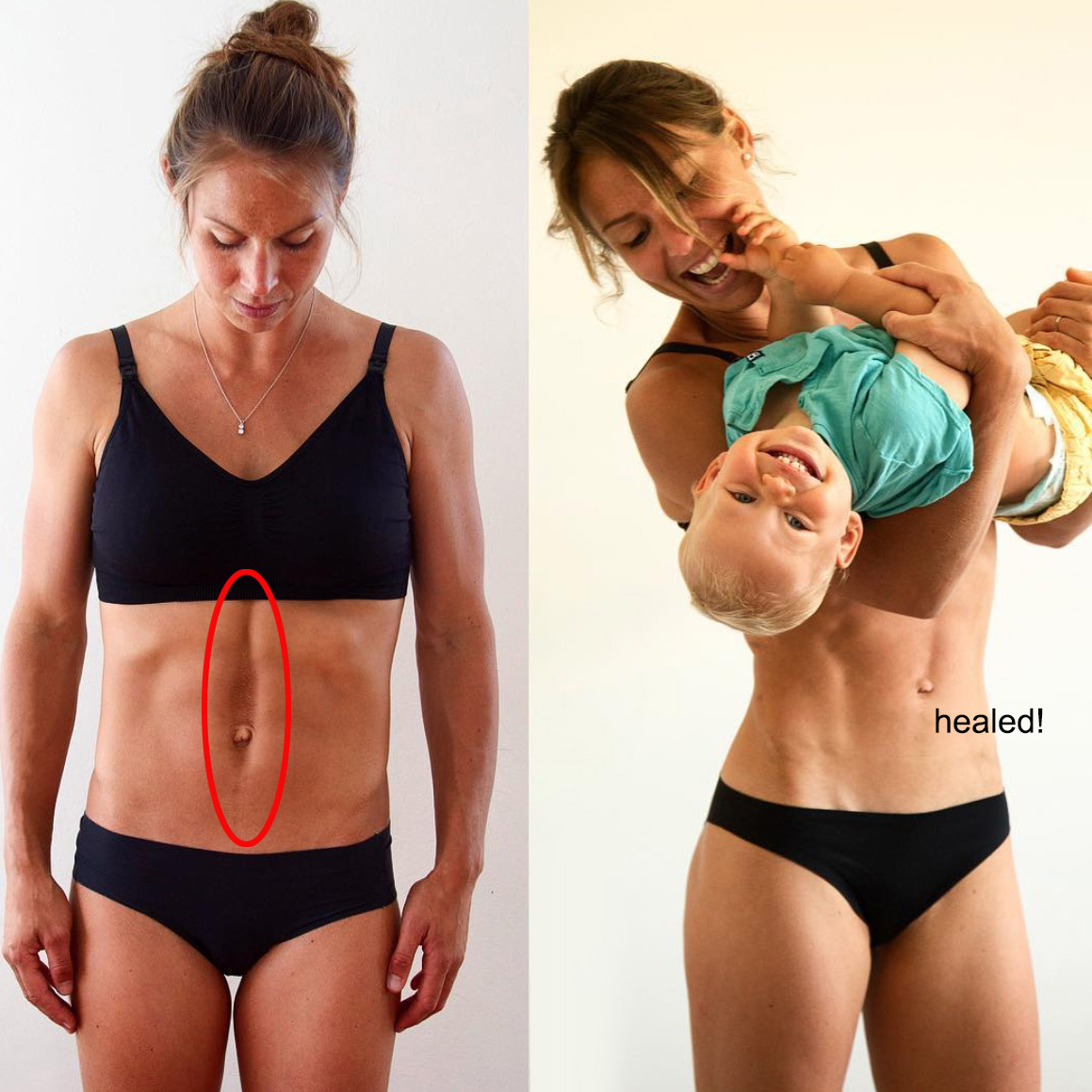 How to Improve Diastasis Recti After Baby