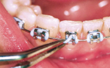 An elastic ligature has come off part of the bracket.