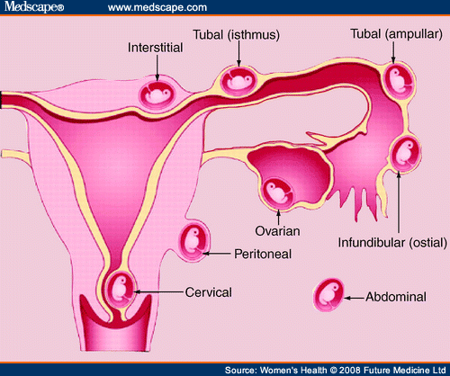 Ectopic pregnancy-Ohio-abortion-bill-51719.gif
