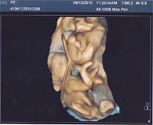 3D scan showing the miracle triplet formation.