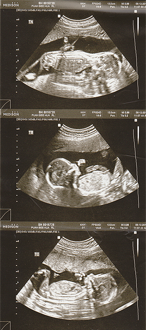We’re gonna have 2 boys 1 girl! Doctor refer them as Triplet ABC A (boy), B (boy), C (girl)