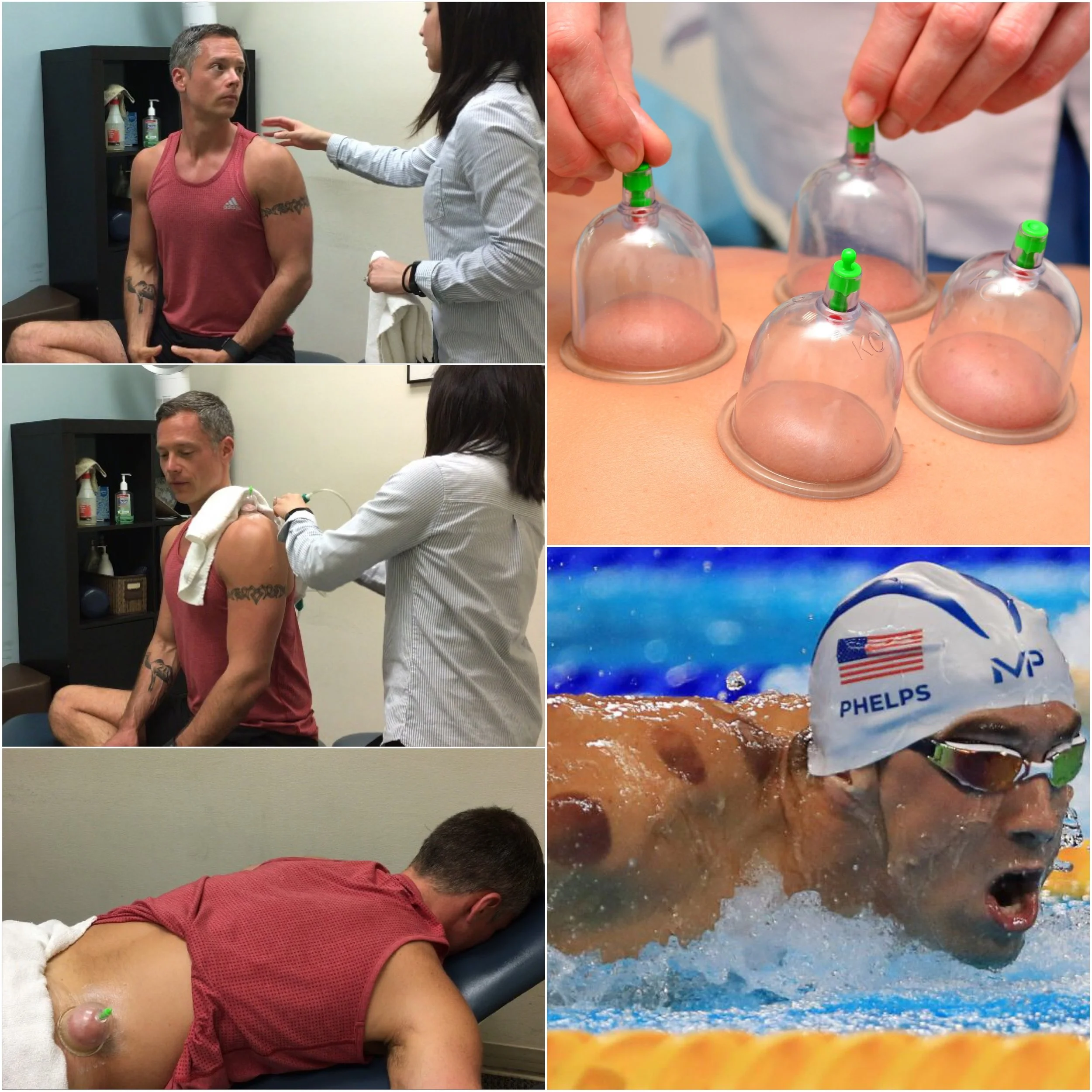 Curious About Cupping? Dr. Jay and JJ Demo How It Can Improve Fascia