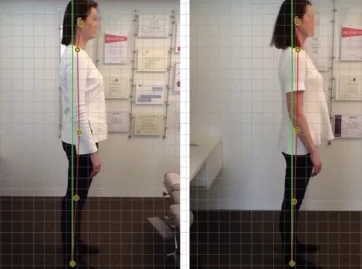 Not all of our client's have blurred faces but many of them do have FHP. In this photo, you can see a client's progress from where her head started on the left, to where she is headed now. She still has some way to go, however we can tell that she is headed in the right direction. *Individual results may vary.