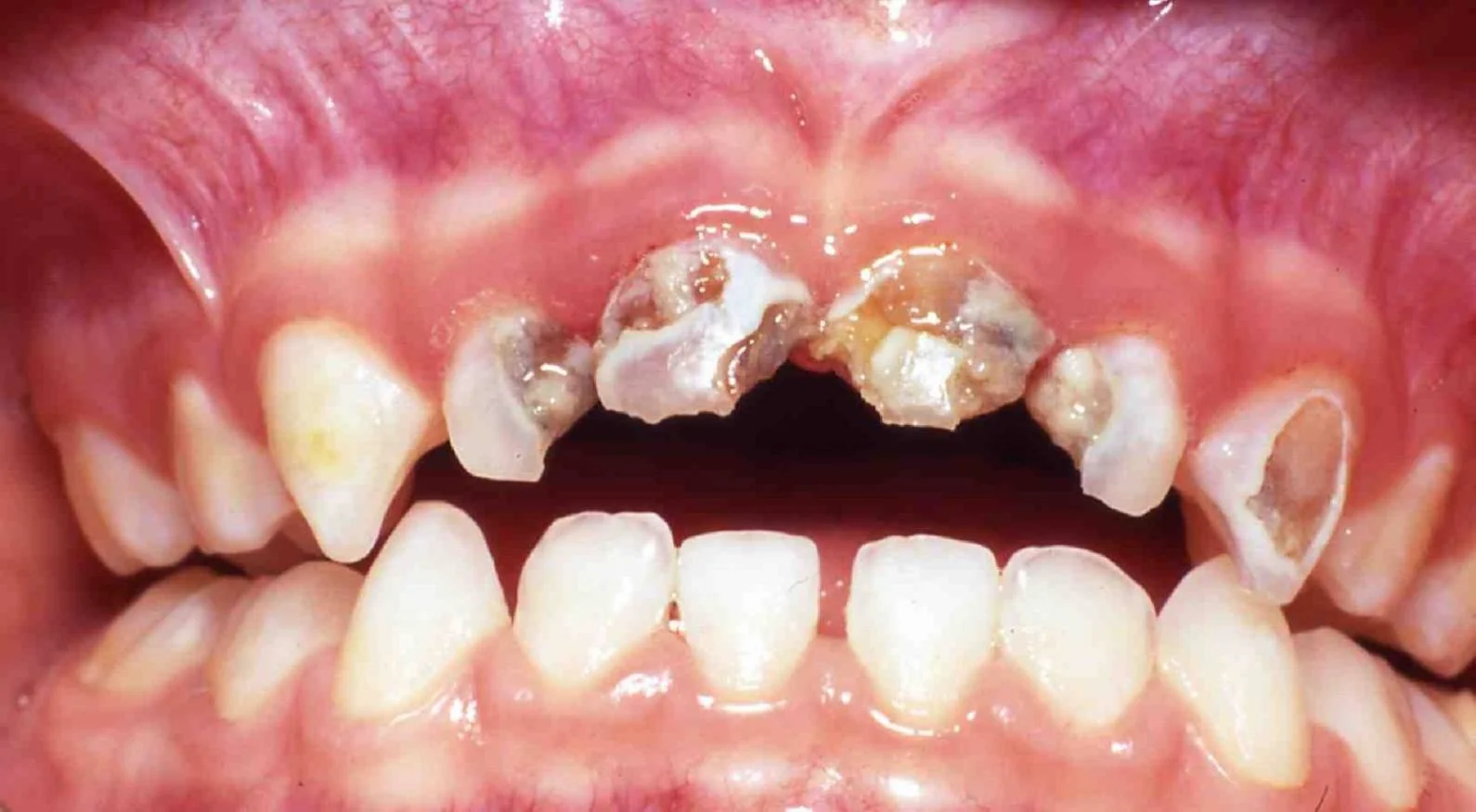 Sugar/Acid consumption. Timing makes a difference.