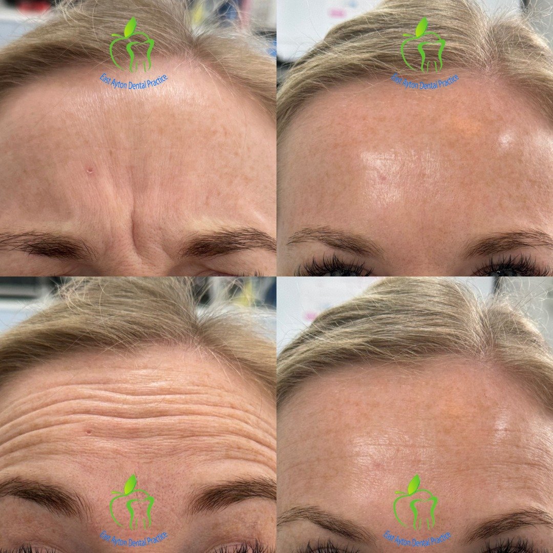 Facial Aesthetics are non-surgical treatments that can enhance your appearance and soften the effects of ageing.

These include Botulinum toxin and Dermal Fillers with HA, either or both can be used.

We can treat the face and neck. Lines &amp; wrink