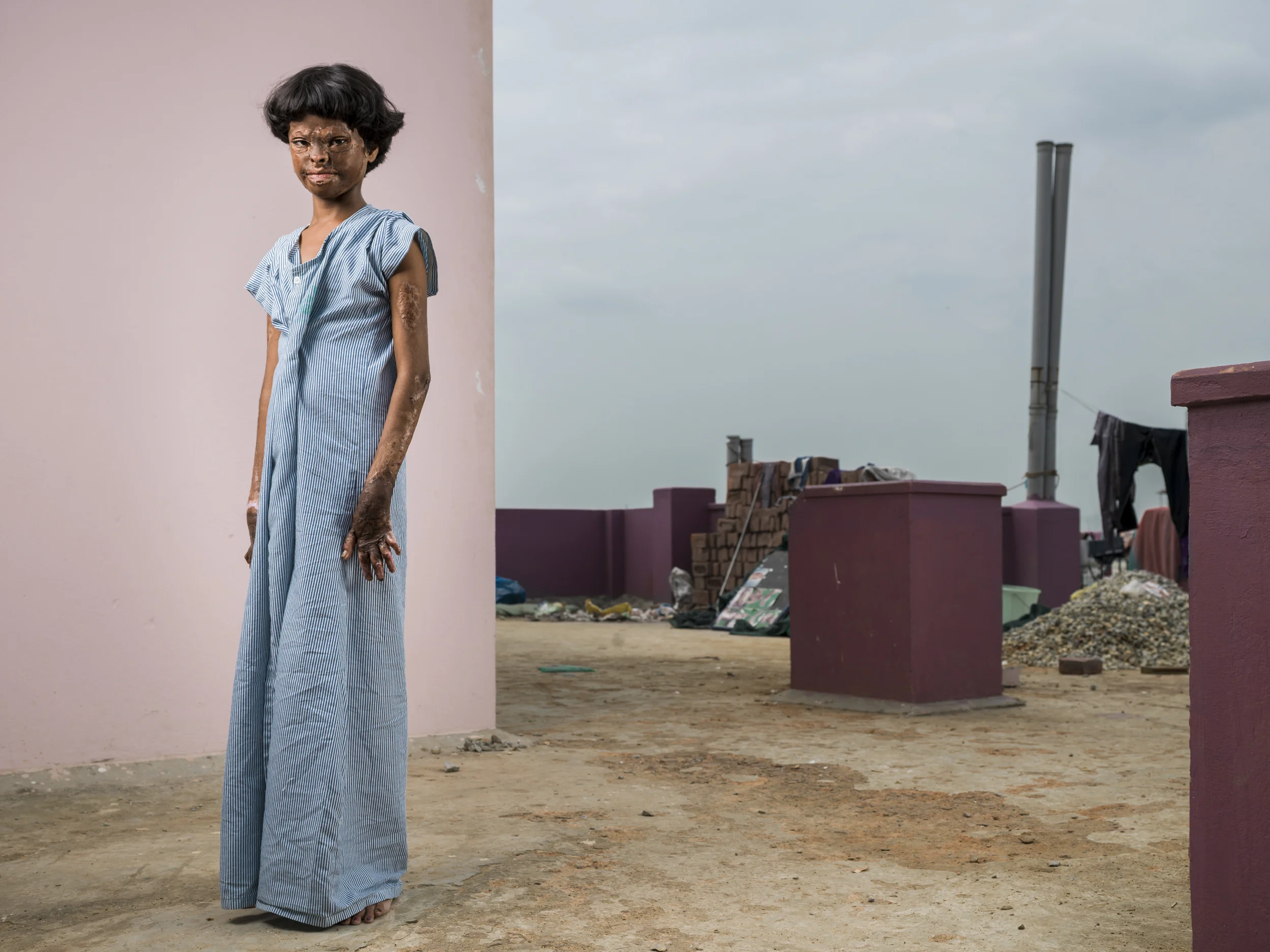 VARANASI, INDIA, 5 SEPTEMBER 2014: VARANASSI, INDIA, 2 OCTOBER 2013: Kumkum Chowdhary, 13, poses on the roof of a small donor hospital in Varanassi, India. She is seen 10 months after she first underwent surgery to heal her terrible burns. This is one of the very few facilities in India to offer plastic surgery to the poor. Kumkum is a victim of severe burns from a gas fire. India has one of the highest incidents of severe burns per capita yet has very few hospital burns units throughout the country. Kumkum was severely burned when a naive boy in her village asked to hold a candle while he tried to transfer gas from one canister to another. He promised Kumkum a sweet if she would help him. The resultant explosion burnt her over most of her body, the boy was uninjured and ran away. Kumkum has been in this condition for more than three years with only basic medical care. Her parents are poor people and they cannot afford the necessary travel let alone medical care she requires. This hospital in Varanassi is one of the very few the poor can access. It is based on the efforts of a single doctor, a plastic surgeon who has made it his priority to serve the poor who would otherwise never be able to access this kind of surgery. It will require at least 5 years of succesive surgeries and recovery before she will be able to lead a normal life. This recovery is not something Kumkum would ever be able to access without the help of this unique facility.