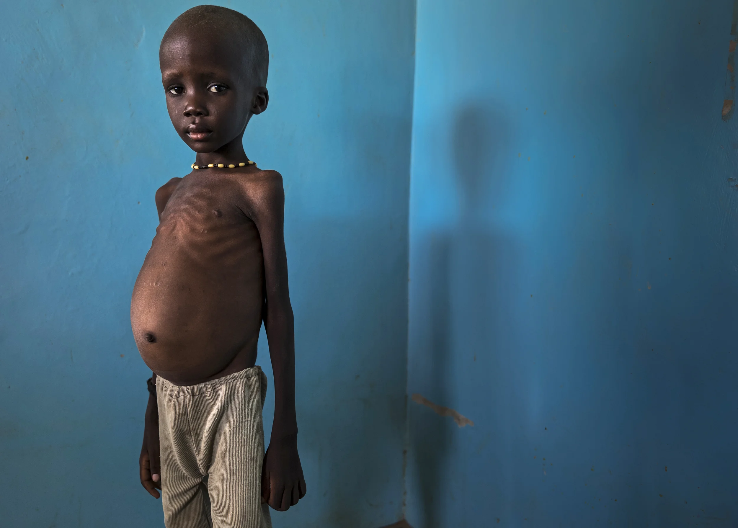 Turkana, North Kenya, October 9 2014: A severely malnourished Turkana child who’s family has been driven out of their traditional land by invading Dassanech from Southern Ethiopia. The Dassanech have themselves been forced to relocate by new Ethiopian Sugar Cane farms and Dam projects which have reduced the flow of water in the Omo river by four fifths of its usual size. This is now affecting over 600 000 armed tribesmen on both side of the Ethiopia/Kenya border and conflict is increasingly the norm.