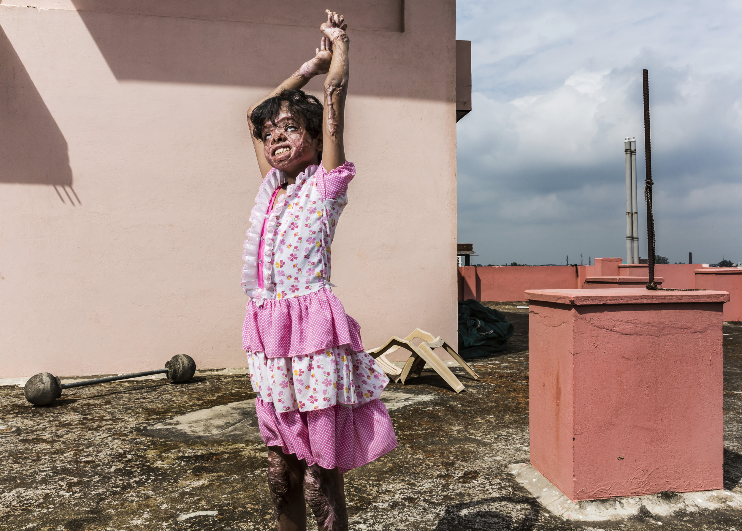 VARANASSI, INDIA, 2 OCTOBER 2013: Kumkum Chowdhary, 12, plays by herself on the roof of a small donor hospital in Varanassi, India. Kumkum is a victim of severe burns from a gas fire. India has one of the highest incidents of severe burns per capita