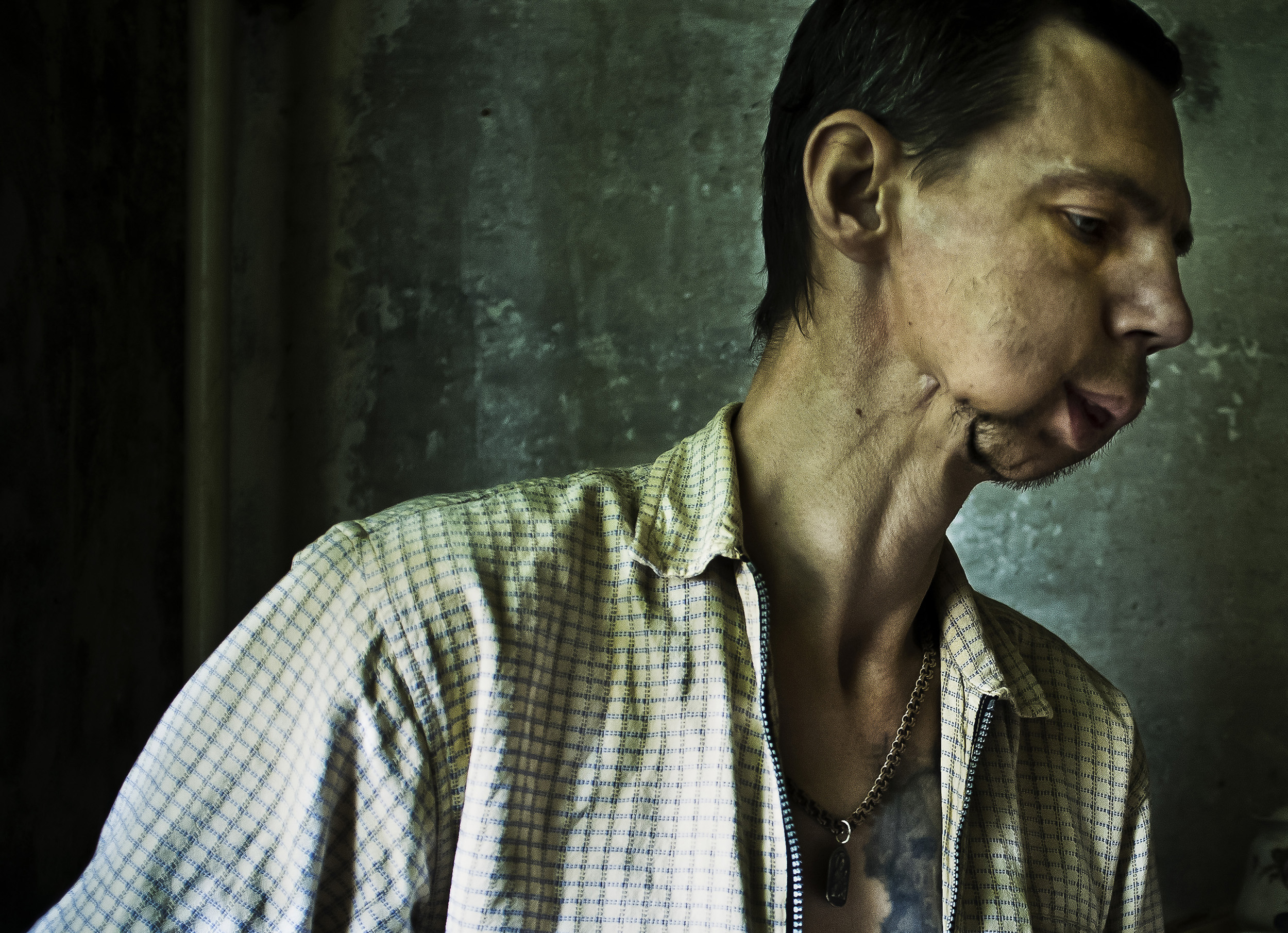 KHARKOV, UKRAINE, AUGUST 2011: An HIV+ addict who has lost his lower jawbone to the corrosive effects of "Krokodil," a deadly new Ephedrine based Amphetamine drug photographed in a small apartment in a housing project in Kharkov, Ukraine, 28 August