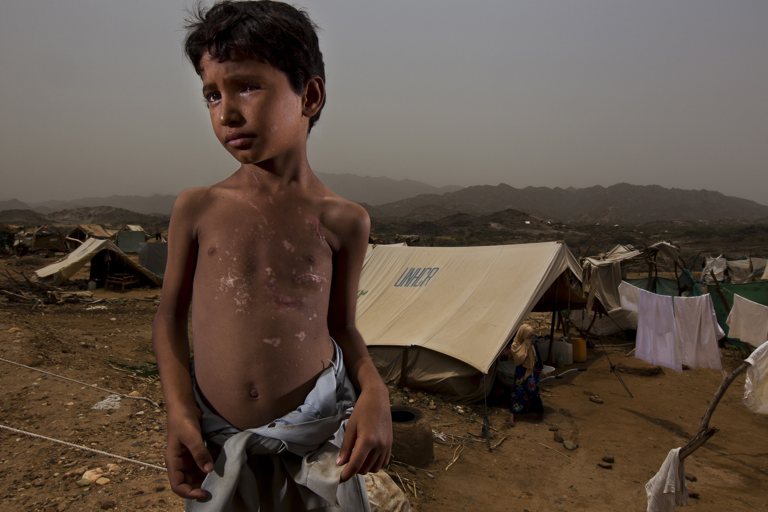 AL-MAZRAQ, YEMEN, AUGUST 2010: War victim eight year old Abbas, is seen at the Al-Mazraq IDP camps, Al-Mazraq, Yemen, August 14, 2010. Abbas was walking with his uncle in the Sa'ada region when his uncle stepped on a landmine and was blown to piece