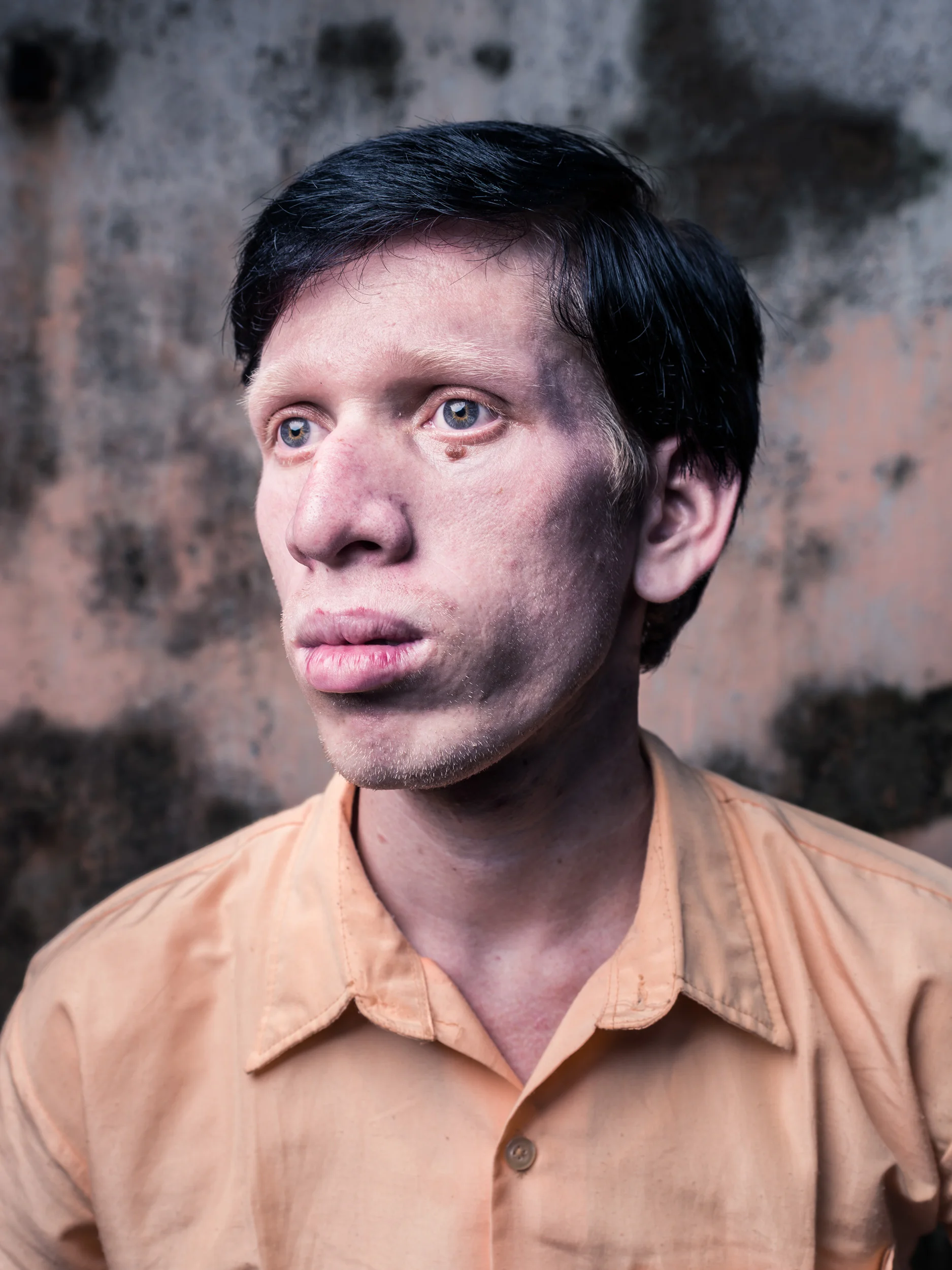 Blind Albino Boys - Vivekananda Mission School for the Blind - India, West Bengal, September 19, 2014.