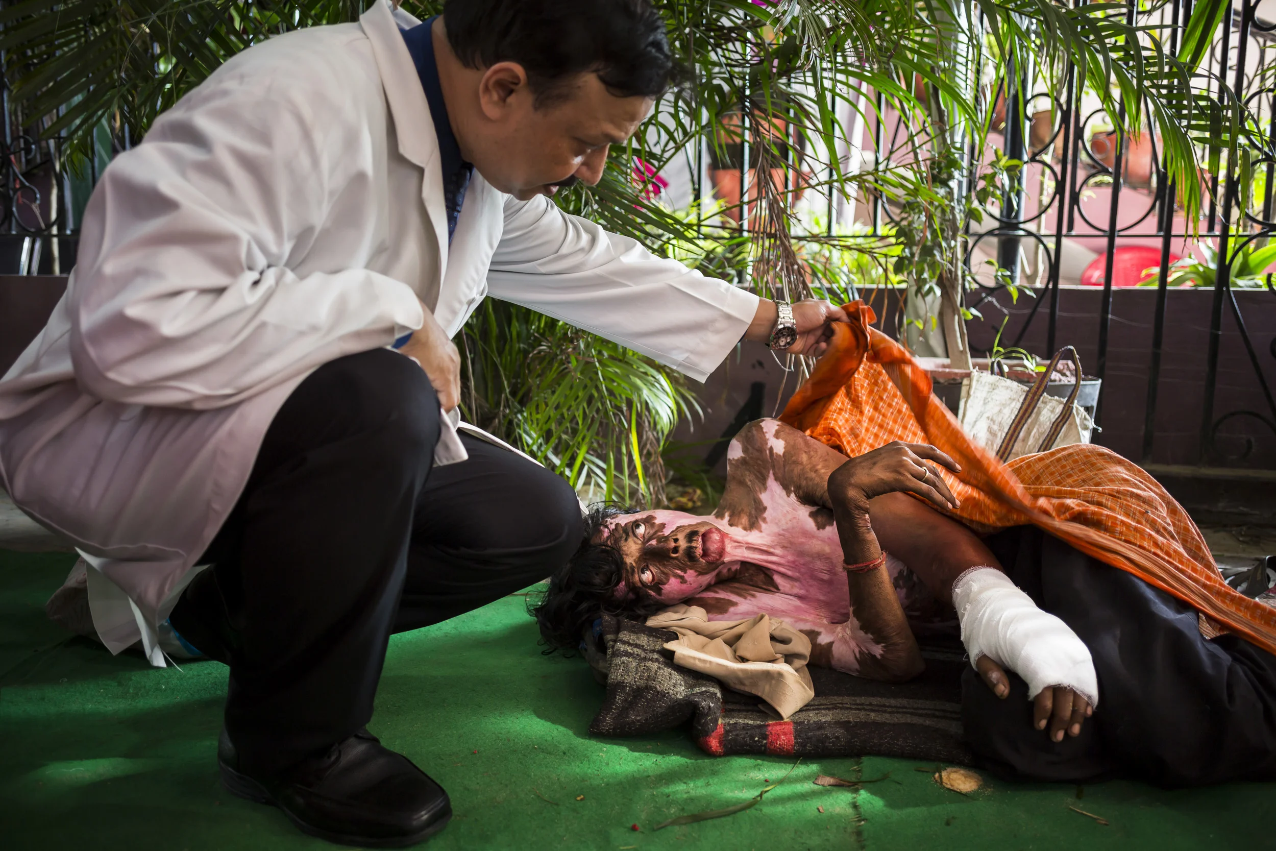 VARANASI, INDIA, 5 SEPTEMBER 2014: Renowned plastic surgeon to the poor, Dr Subodh Singh holds a burns camp for some of the over 6 million people burnt in India every year. Most victims are deeply impoverished and like millions of India's poor are unable to secure the necessary surgery. Renowned plastic surgeon to the poor, Dr Subodh Singh has devoted his life to providing life changing surgery to the poorest of the poor in Varanasi, India. (Photo by Brent Stirton/Reportage by Getty Images.)