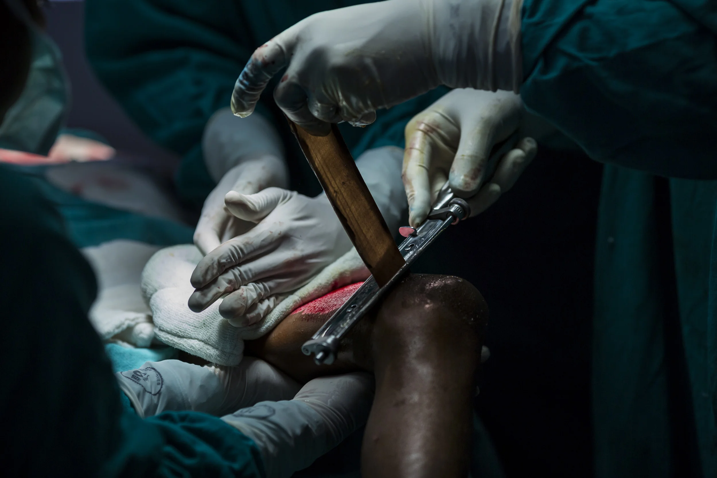 VARANASI, INDIA, 8 SEPTEMBER 2014: Renowned plastic surgeon to the poor, Dr Subodh Singh operates on burn victim Ragini Kumari, 10, who was badly burnt by a Kerosene fire when she was 2 years old, she is one of over 6 million people burnt in India every year. Ragini has suffered constrictions of her neck and shoulders and lived in a permanently cramped and restricted postion ever since. Her family is deeply impoverished and like millions of India's poor she has been unable to secure the necessary surgery. Renowned plastic surgeon to the poor, Dr Subodh Singh, found Ragini at a burns camp he held in her area and has arranged for her to attend his clinic where he performs free surgery for the poorest of the poor of India. She is seen at her home before surgery and on her journey to his clinic in Varnasi, India. (Photo by Brent Stirton/Reportage by Getty Images.)