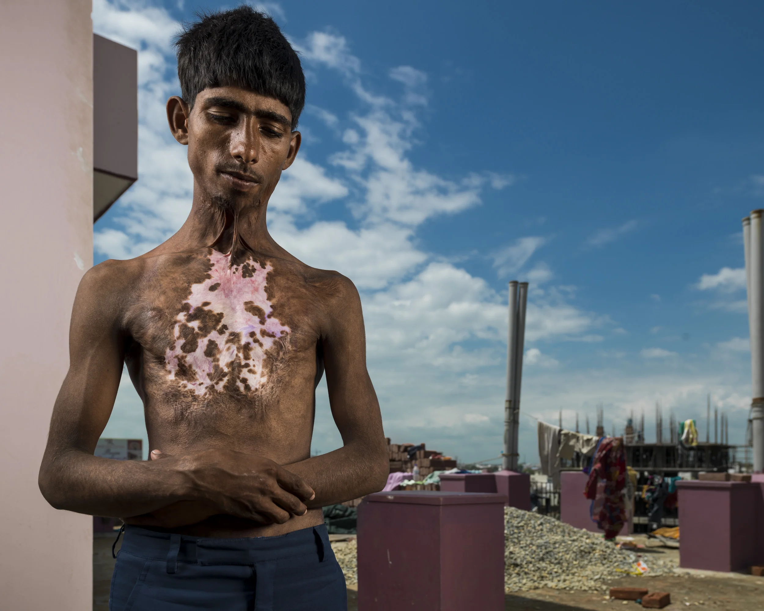VARANASI, INDIA, 5 SEPTEMBER 2014: Burn victims seen at one of the very few burns camp offering free plastic surgery to the poor, a tiny fraction of the estimated 6 million people burnt in India every year. Most victims are deeply impoverished and like millions of India's poor are unable to secure the necessary funding for surgery. Huge numbers of people thus live lives of incredible, daily suffering without respite. India's poor has a heavy reliance on liquid fuels for cooking and light and this combined with its huge and dense population leads to the highest numbers of burn victims globally.