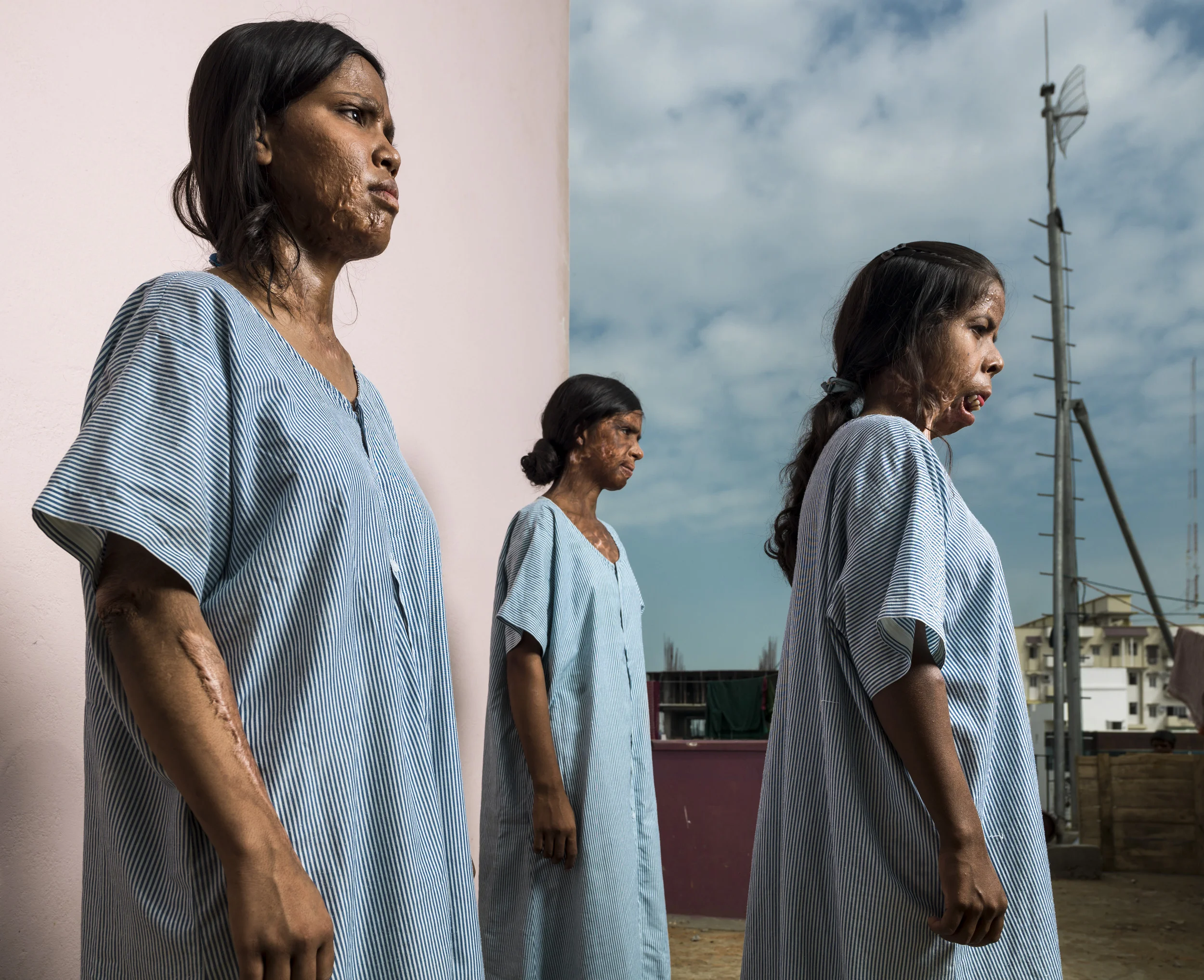 VARANASI, INDIA, 5 SEPTEMBER 2014: Burn victims seen at one of the very few burns camp offering free plastic surgery to the poor, a tiny fraction of the estimated 6 million people burnt in India every year. Most victims are deeply impoverished and like millions of India's poor are unable to secure the necessary funding for surgery. Huge numbers of people thus live lives of incredible, daily suffering without respite. India's poor has a heavy reliance on liquid fuels for cooking and light and this combined with its huge and dense population leads to the highest numbers of burn victims globally.