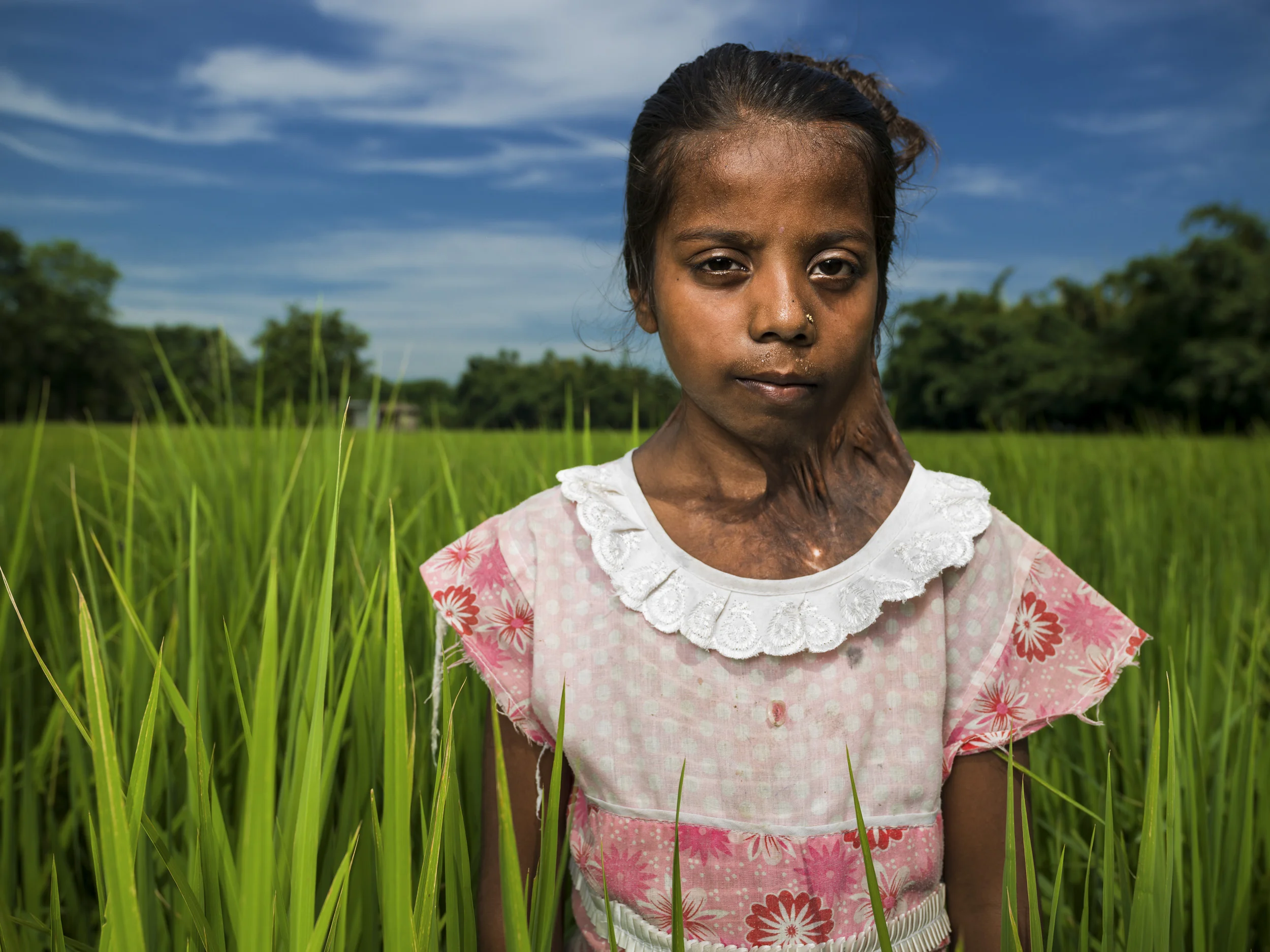 MUZZAFARPUR, INDIA, 5 SEPTEMBER 2014: Ragini Kumari, 10, was badly burnt by a Kerosene fire when she was 2 years old, she is one of over 6 million people burnt in India every year. Ragini has suffered constrictions of her neck and shoulders and lived in a permanently cramped and restricted postion ever since. Her family is deeply impoverished and like millions of India's poor she has been unable to secure the necessary surgery. Renowned plastic surgeon to the poor, Dr Subodh Singh, found Ragini at a burns camp he held in her area and has arranged for her to attend his clinic where he performs free surgery for the poorest of the poor of India. She is seen at her home before surgery and on her journey to his clinic in Varnasi, India. (Photo by Brent Stirton/Reportage by Getty Images.)