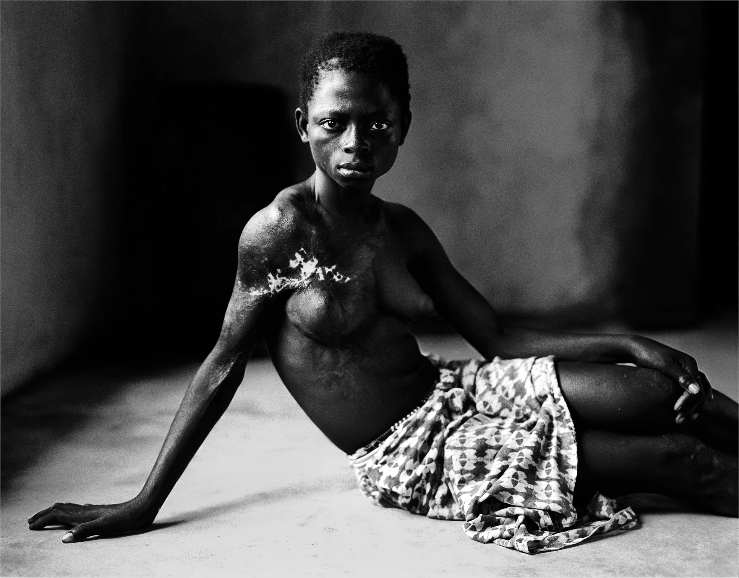 KONO, SIERRA LEONE-OCTOBER 2003: A 12 year old former "bush-wife" sex-slave of the rebel group the R.U.F. This girl was taken from her village at 10 years old and forced into sexual servitude by the rebels. When she attempted to escape they used battery acid to burn off her breast as an example to the other slaves. PHOTO BY BRENT STIRTON/GETTY IMAGES.