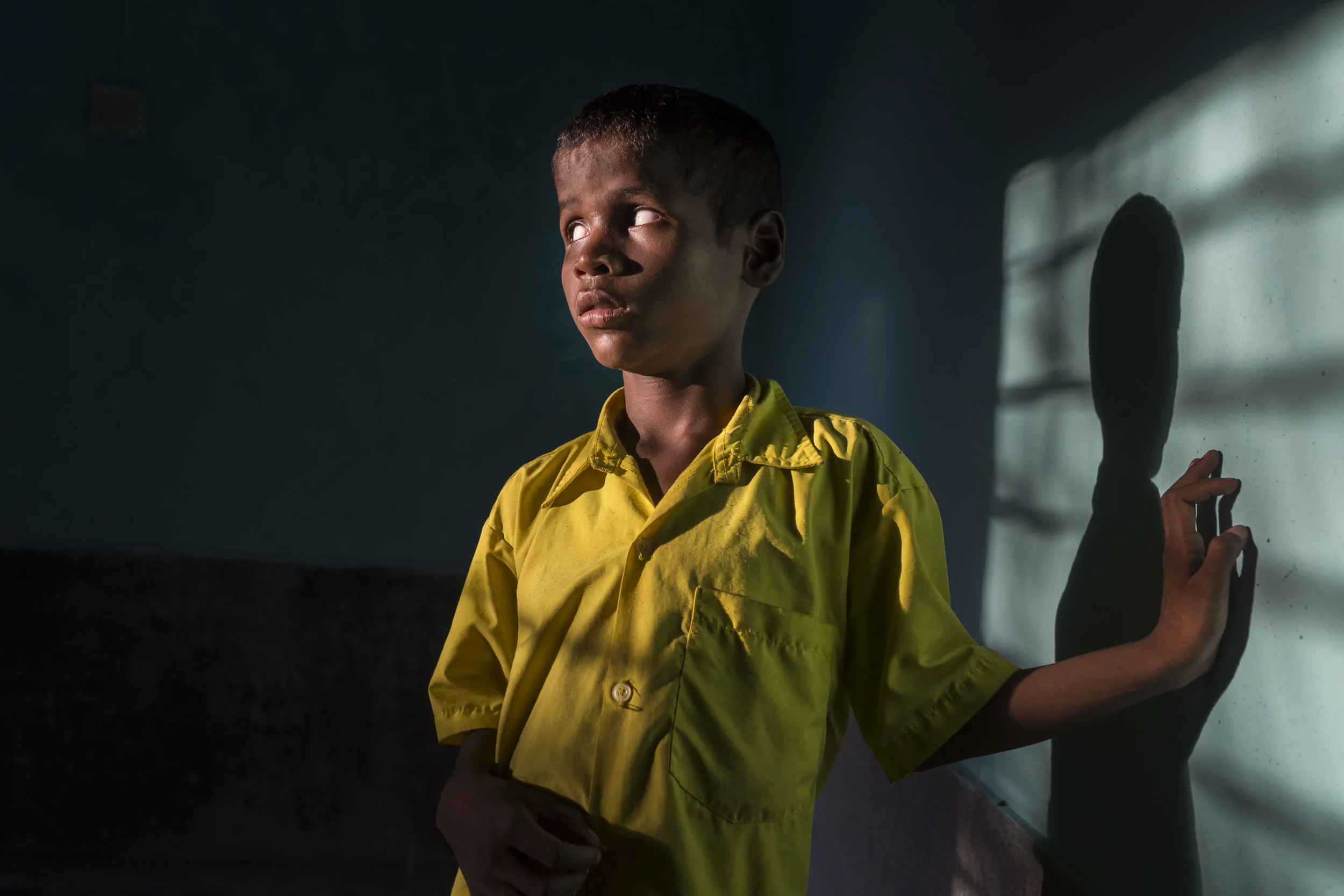 WEST BENGAL, INDIA, 17 SEPTEMBER 2014: Bharat Mallik, 7, is a boy who suffers from Cataract blindness and comes from a severely impoverished Bengali family in India. He is seen at Vivekananda Mission Hospital, an eye hospital which specializes in treating the poor for little or no money. Bharat’s father is a drunk and his labourer mother struggles to make ends meet. As a result he has not been treated for his cataracts. A teacher network at school notified a local social worker and as a result of his efforts Bharat is scheduled for surgery at Vivekananda Ashram hospital a few hours away. Most of these villagers are so poor that transport to a hospital is not possible. As a result many children go permanently blind when like Bharat, a simple operation can restore their sight. (Photo by Brent Stirton/Reportage by Getty Images.)