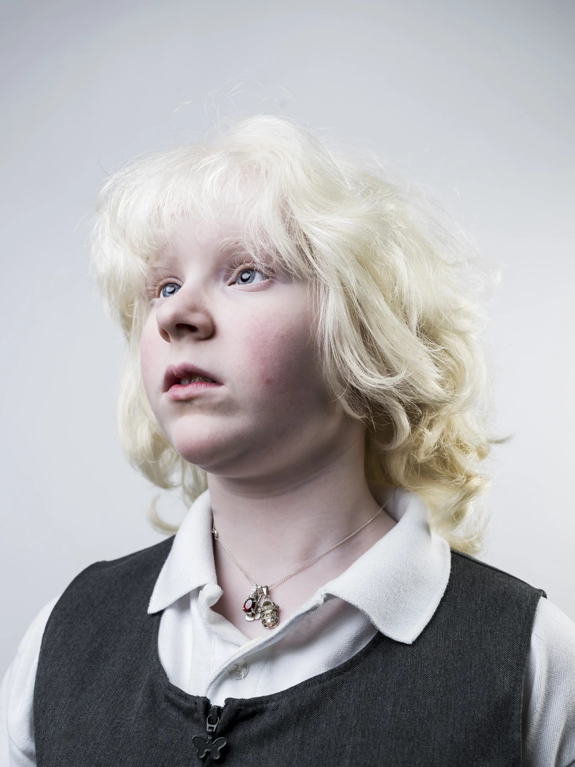 A schoolgirl with Ocular Albinism. Ireland