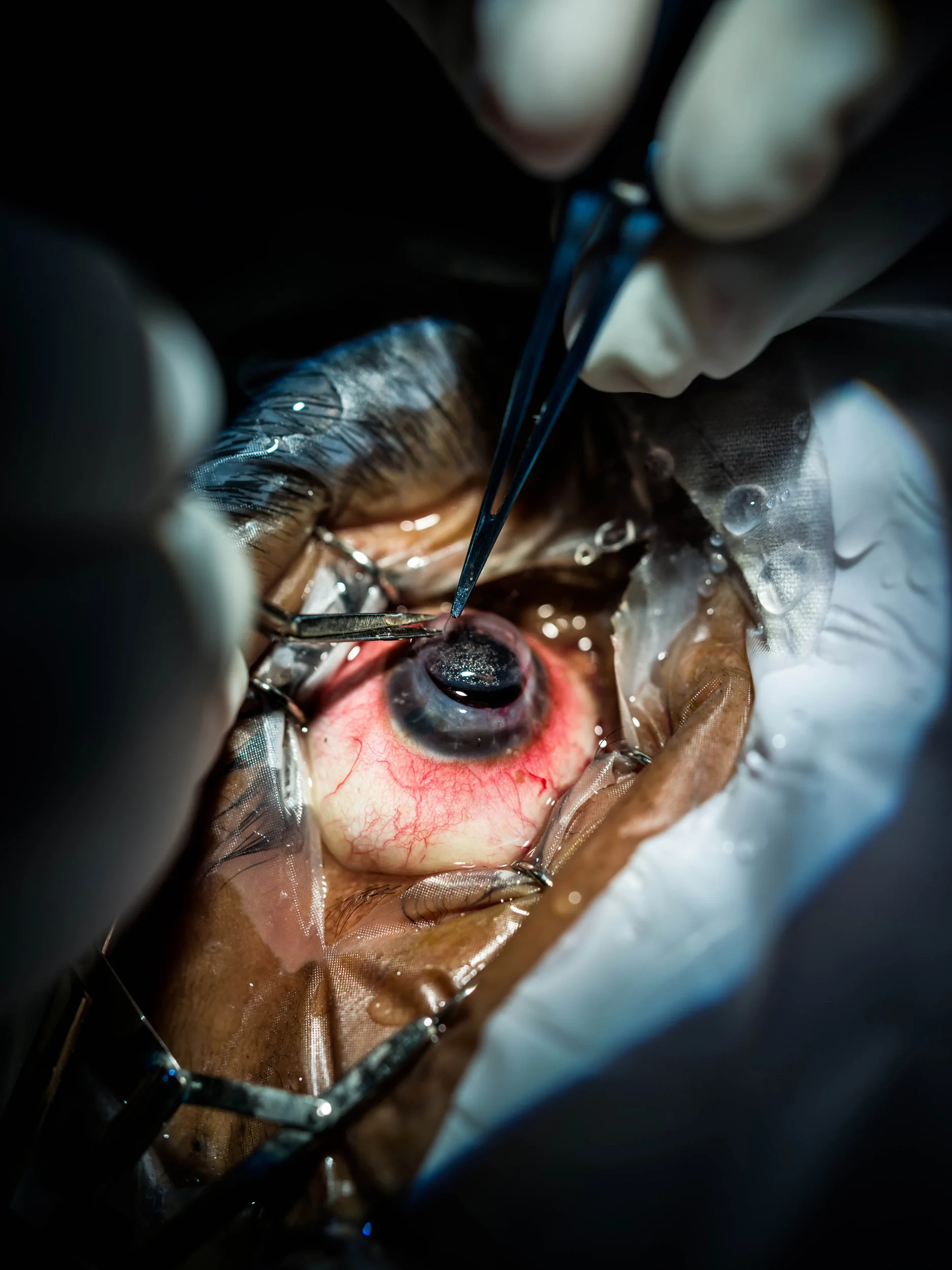 KOLKATA, INDIA, 13 JANUARY 2016: A Corneal graft is performed at the Vivekananda Mission Asram hospital on the outskirts of Kolkata. A cornea from a deceased donor is cut to precise measurements, the patients internal cataract is removed, a lens inserted and then the new Cornea sewn on to the eye. The entire procedure takes just over one hour to perform and in this case was performed free for a man who could not afford this treatment, a case representing most of the people in India in need of this kind of surgery. (Photo by Brent Stirton/Reportage for National Geographic Magazine.)
