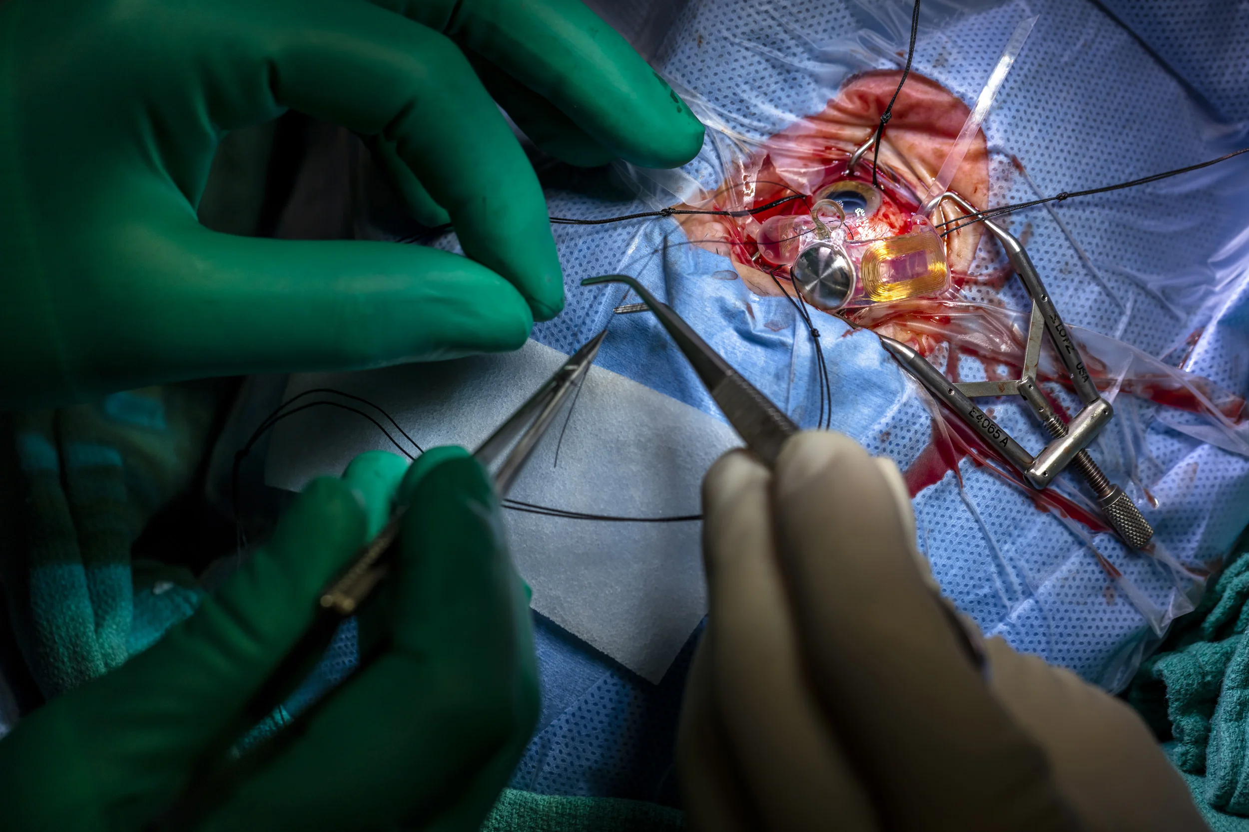 DUKE EYE CENTER, RALEIGH-DURHAM, NORTH CAROLINA, 9TH FEBRUARY 2016: Karen Brown, 59, was born with Retinitas Pigmentosa. As a result she experienced very limited sight as a child and then went blind. She is seen at Duke Eye center as eye surgeons implant an Argus 2 retinal implant which will lay an array of 60 electrodes across one of her eyes. This implant will connect to an external device which will bring Karen a version of the world around her translated into what will look light shapes and flashing lights. Second sight provides the following definition of the technology online: "The Argus® II Retinal Prosthesis System ("Argus II") is also known as the bionic eye or the retinal implant. It is intended to provide electrical stimulation of the retina to induce visual perception in blind individuals. It is indicated for use in patients with severe to profound retinitis pigmentosa. A miniature video camera housed in the patient's glasses captures a scene. The video is sent to a small patient-worn computer (i.e., the video processing unit – VPU) where it is processed and transformed into instructions that are sent back to the glasses via a cable. These instructions are transmitted wirelessly to an antenna in the retinal implant. The signals are then sent to the electrode array, which emits small pulses of electricity. These pulses bypass the damaged photoreceptors and stimulate the retina's remaining cells, which transmit the visual information along the optic nerve to the brain, creating the perception of patterns of light. Patients learn to interpret these visual patterns with their retinal implant." Karen is operated on by Dr Lejla M Vajzovic and assisted by Dr Paul Hahn at Duke Eye center. Around 150 patients have had the Argus 2 implant so far. It is described as similar to learning another visual language, once patients have learnt this language the world becomes visible to them in a way that could be desbribed as akin to a hazy black and white photograph. (