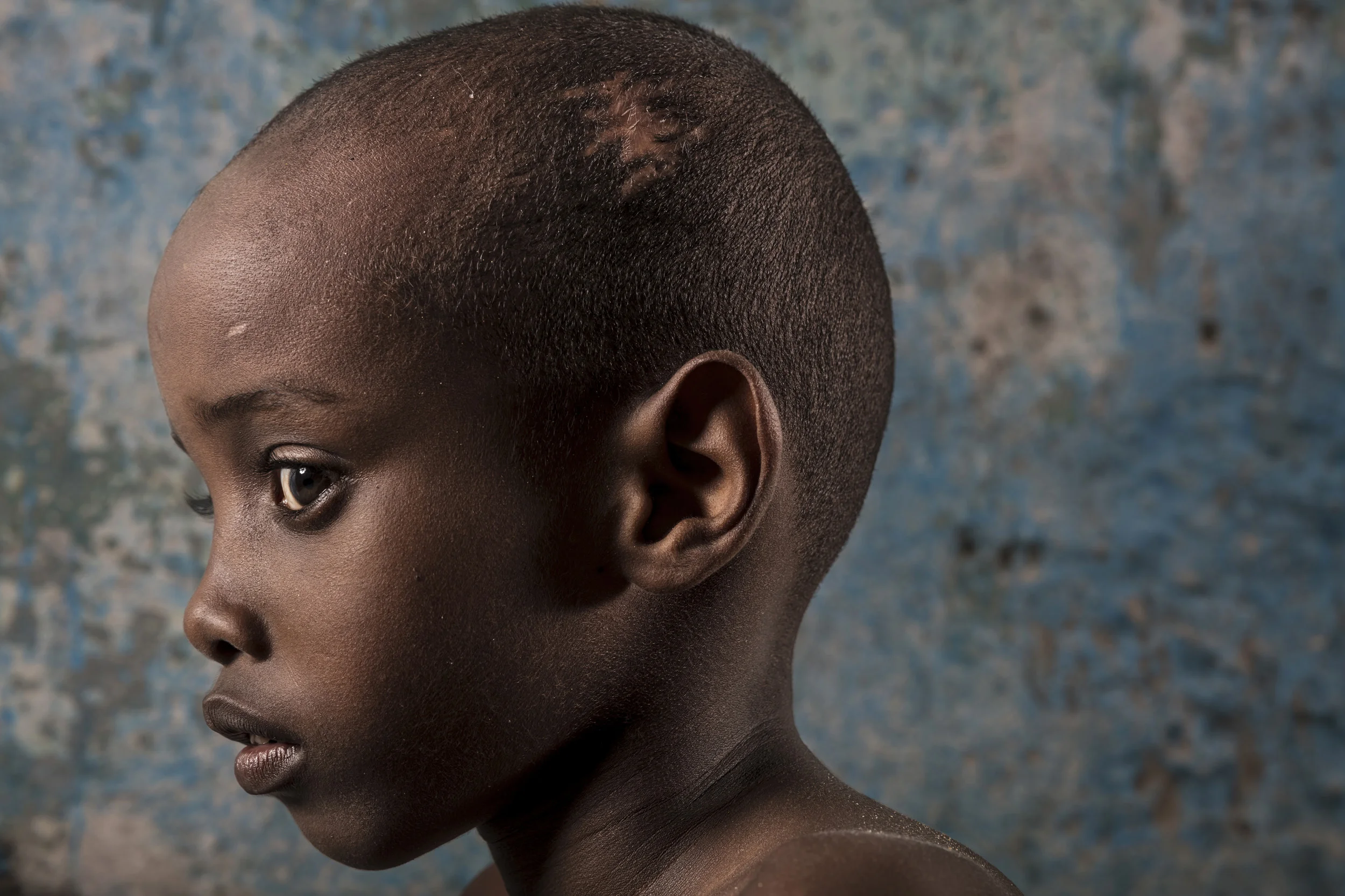 MOGADISHU, SOMALIA, 5 AUGUST 2017: Yahya Jimale Kheyliye, 8, was one of nine children who were hit by an Al-Shabab mortar that was fired at the presidential compound on the day the new president was elected. Two children died and 7 were wounded, most of them were from the Kheyliye family who's home is on the border road close to the president's residence. The new president helped immediately but even when Yahya was sent to Turkey for surgery, the family was told the brain surgery required was too delicate and there was nothing that could be done. Yahya has gone from being a normal happy child to being one with limited motor skills, limited mental capacity and he has lost his ability to speak. This is due to the two pieces of mortar shrapnel that are lodged inside his brain. A Somali who lives in the USA has brought a number of wounded children to the USA for complex surgery, he is working on being able to do the same for Yahya but President Trump's travel ban on Somali's is complicating matters. (Photo by Brent Stirton/Verbatim for Time Magazine.)