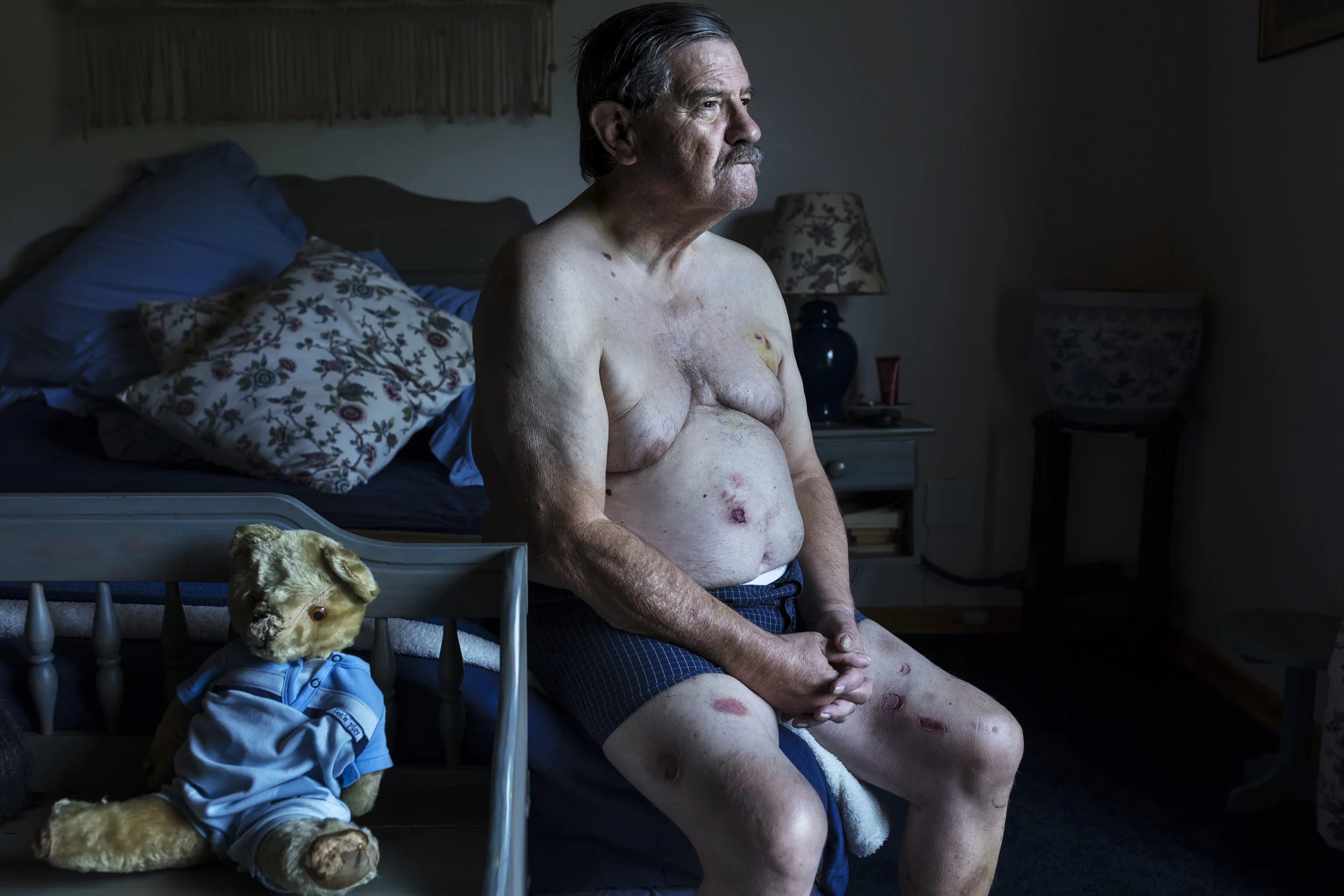 DULLSTROOM, SOUTH AFRICA, 27 FEBRUARY 2017: Robert Lynn, a farm attack victim who lost his wife Sue to a brutal attack last week. The couple were overpowered in their house on the Marchlands farm in Dullstroom, South Africa on Sunday morning. Lynn’s wife, Susan Howarth, passed away in hospital on Tuesday, and Lynn was discharged on Wednesday. He said: “I woke up because the dogs were barking, and there was a racket at the bedroom window. After I sat up in bed, I heard the bedroom glass breaking. I suppose that is when they started shooting at us. I saw three flashes and I assumed they missed. I realized later that Sue was hit immediately in the initial attack” Men wearing balaclavas then pounded on Lynn, hitting him over the head with a gun. He was ordered to lie down. “They kept on asking where the money is. I told them that we don’t keep money, but they would not believe me.” Lynn gave them a couple of hundred rand he had in a money clip and his bank cards, telling his attackers that they would be able to withdraw R1 000 a day from it. Lynn was taken to the living room. Shortly after, attackers started burning him with a blowtorch on his chest and legs. His hands were tied with baling twine and the robbers then started cutting him with a knife in order to get him to confess to keeping more money or a gun safe somewhere. “They were looking for things we just don’t have. I said to them that whoever gave them their information, gave them the wrong information. One of them replied with, ‘No they didn’t.’” Lynn kept on calling to his wife in the bedroom, who he last saw lying in a sleeping position. She did not answer. “The small dark one, who seemed to be the leader, smacked me over the head with his gun and told me to shut up.” Lynn was put in the back of their Nissan Hardbody doublecab. His attackers pulled a black bag over his head. “I suppose they wanted to suffocate me, but I managed to bite a tiny hole through the bag through which
