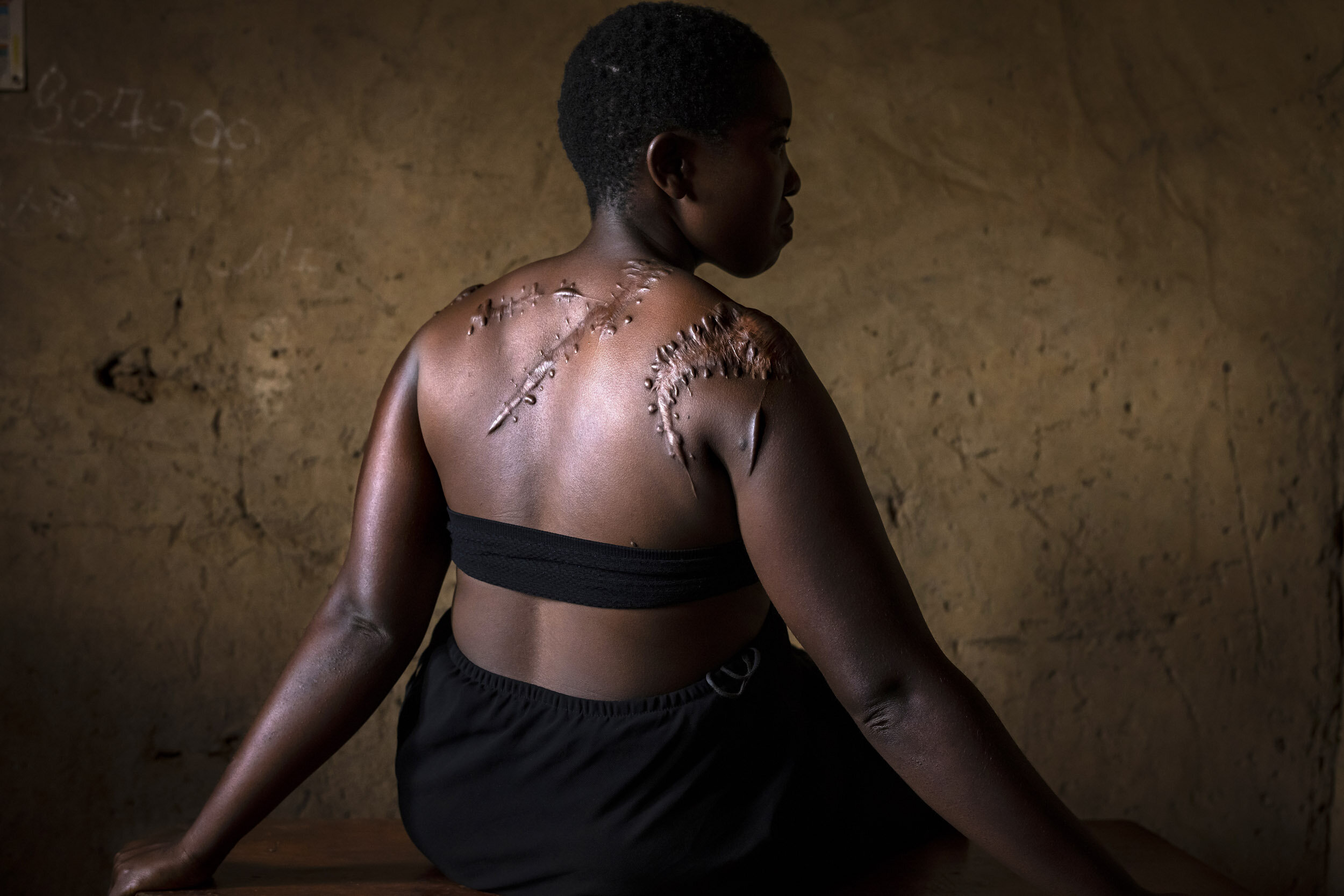MBAOU, BENI, DEMOCRATIC REPUBLIC OF CONGO, 6 APRIL 2021: Georgette Ndovya Kavugho, 32, was attacked by members of the A.D.F Islamist group in her home on the 16th of November 2019. They struck her with machetes, leaving deep cuts in the flesh of her