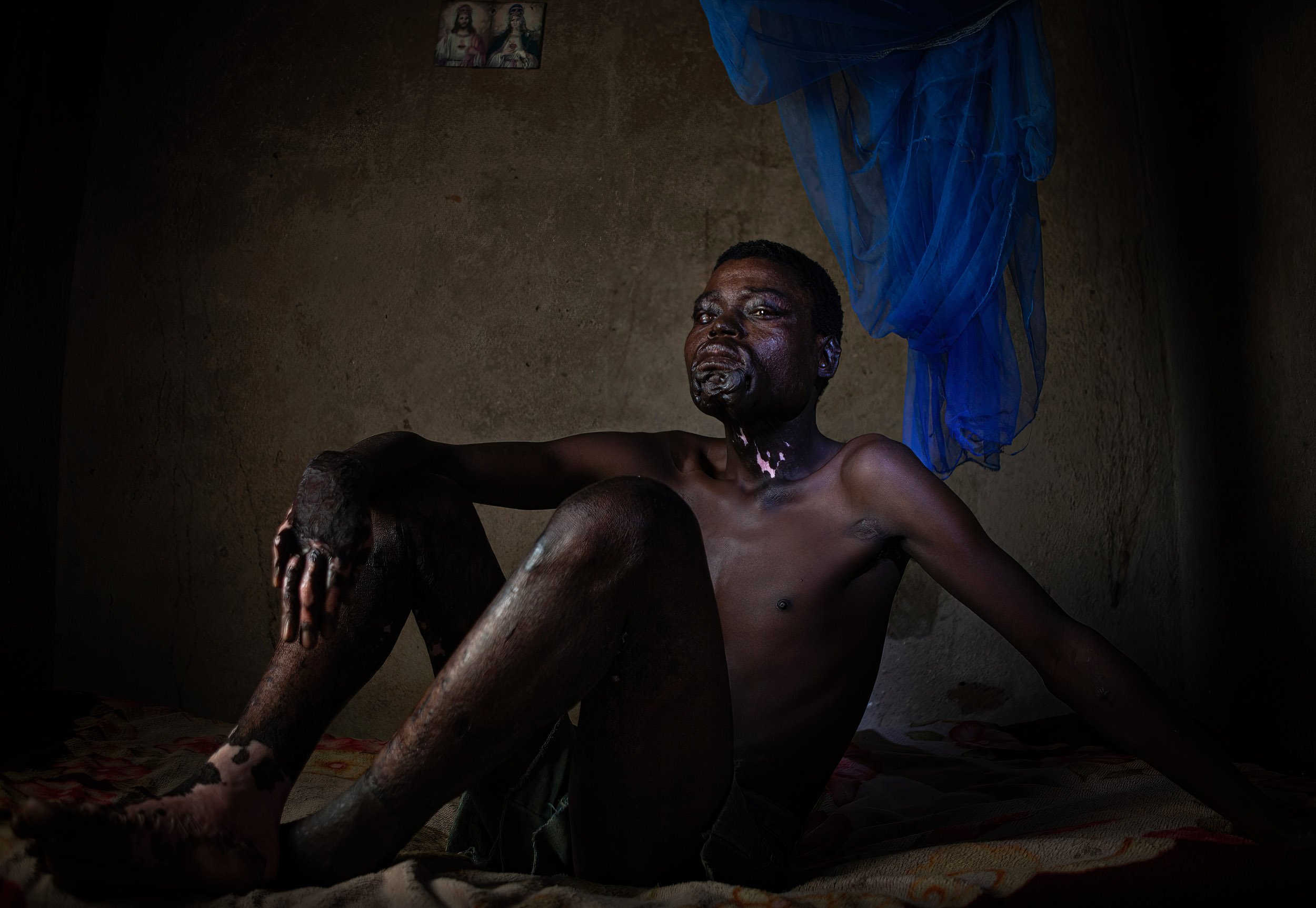 ZAKA, ZIMBABWE, JUNE 2009: A young MDC Zimbabwe oppostion party burn victim, name withheld, sits alone in his room in a rural area of Zaka, Zimbabwe, 24 June 2009. At the conclusion of 2008's March elections in Zimbabwe where the MDC emerged the win