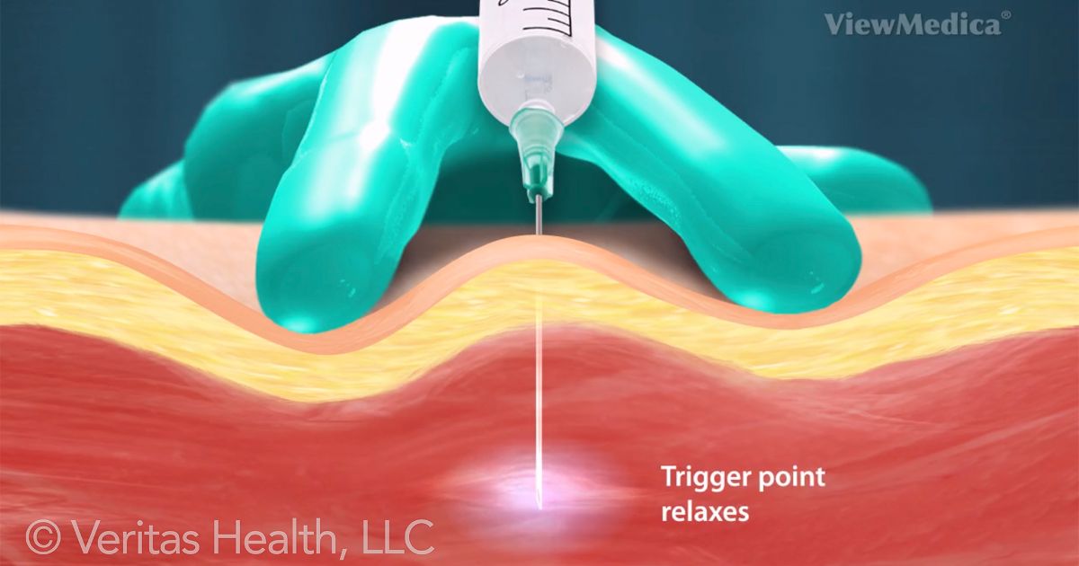 trigger-point-injections.jpeg