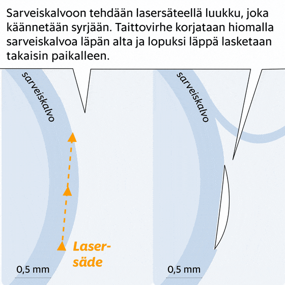 HS: Heijastumia, vääristymiä, kovaa särkyä ja roskan tunne silmissä – Kuinka turvallisia suositut laserleikkaukset ovat? Asiantuntija vastaa