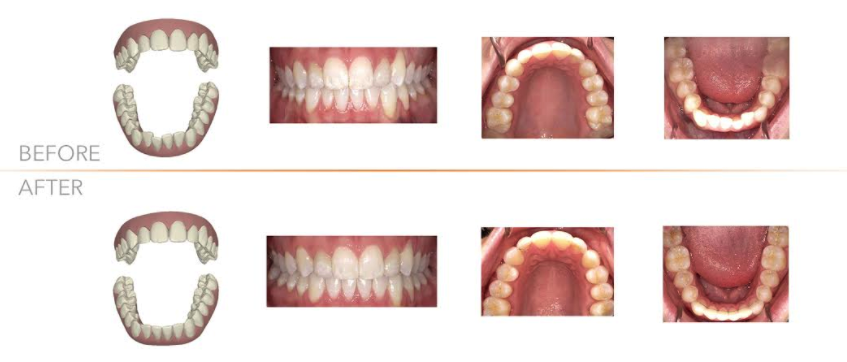 invisalign.png