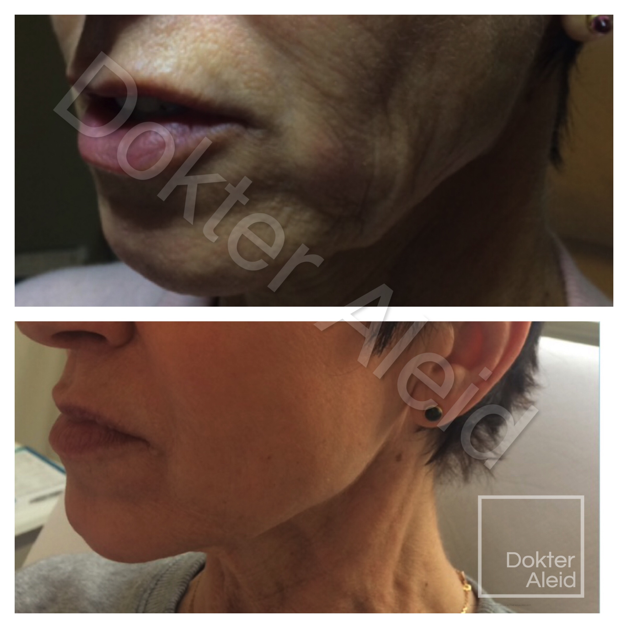 Filler (Radiesse) wangen.