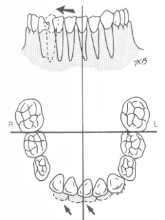 Premature loss of a Primary Canine - Courtesy Dr. T. K. Barber