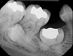 Ankylosis of the Second Primary Molar - Second Bicuspid Malpositioned