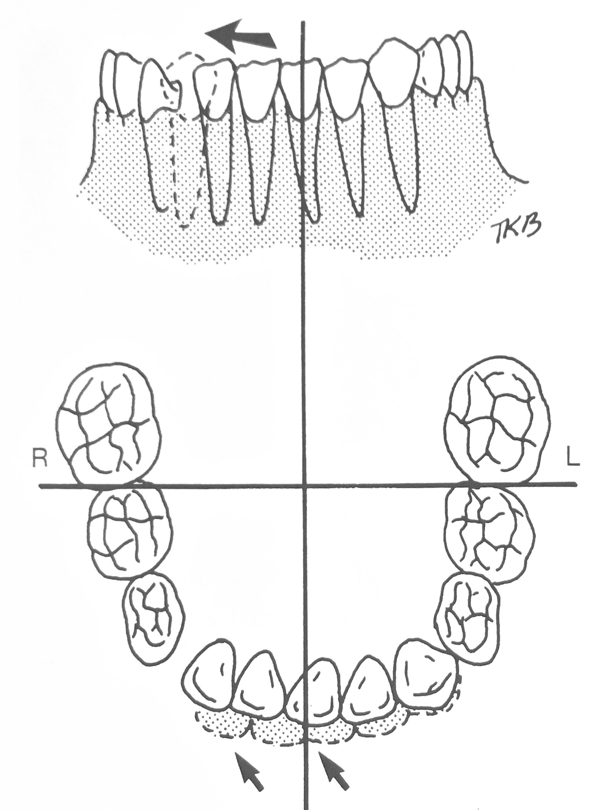 Midline shift courtesy Dr. Thomas K. Barber