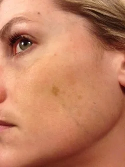Pic taken circa 2014, prior to any peel treatments. 