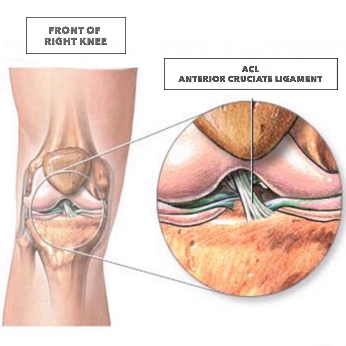 Полный разрыв передней крестообразной. Крестообразные связки анатомия. Лигамент коленного сустава. Лигаментит связок коленного сустава.