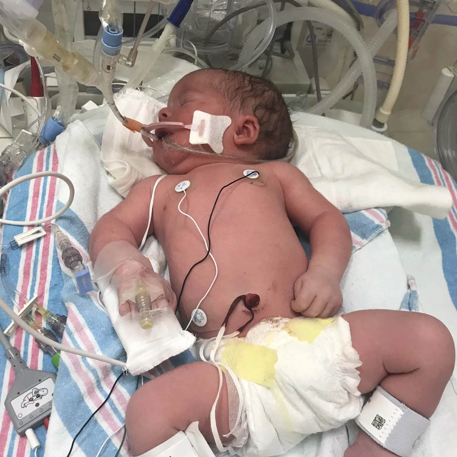fore-hadley-foundation-congenital-diaphragmatic-hernia-cdh-support