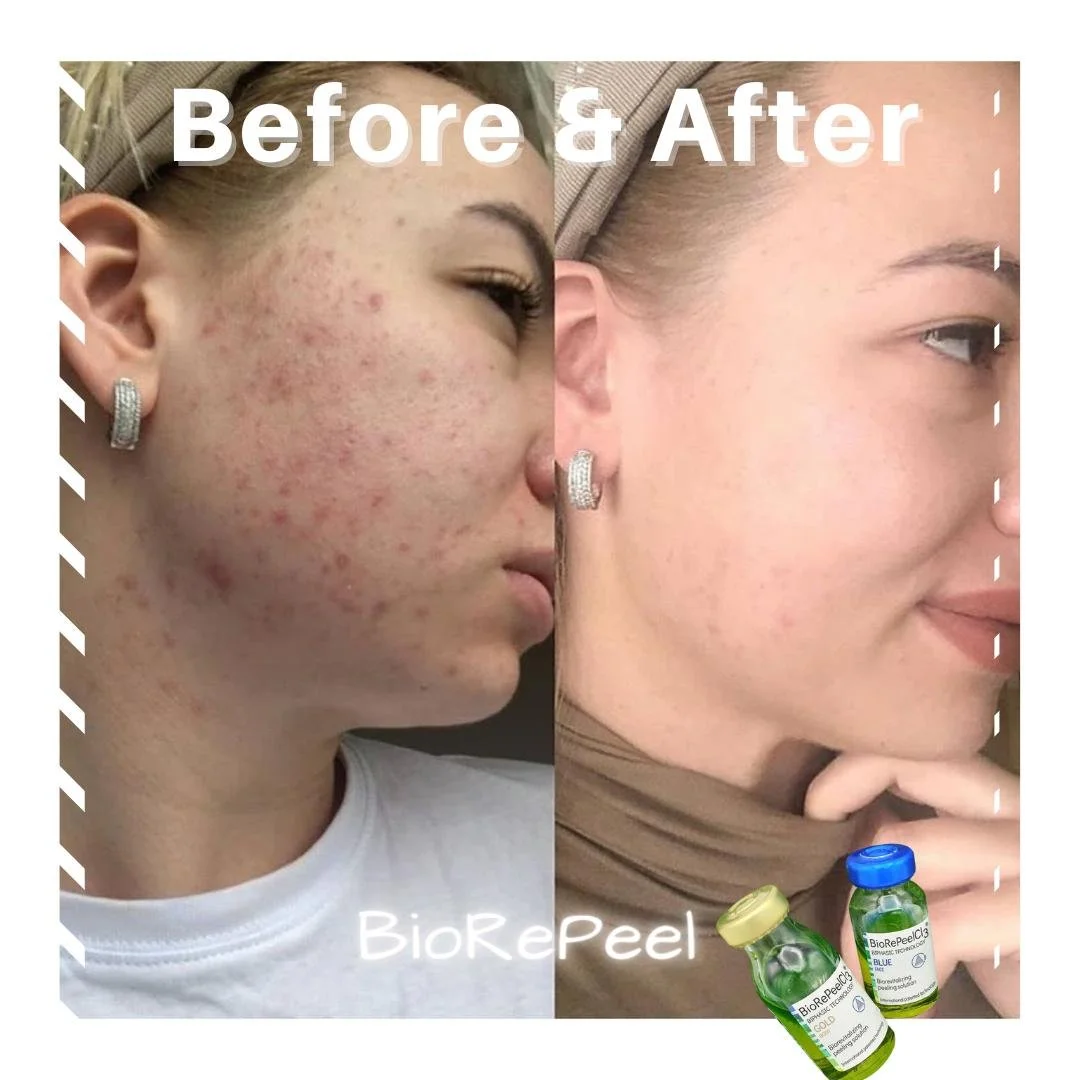 BioRePeel DERMASPACE biorepeel-dermaspace