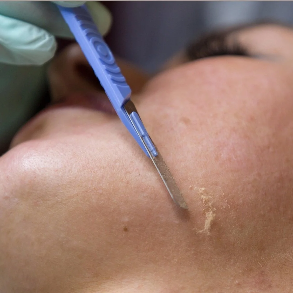 Dermaplaning The Perfect Pairing With Our Iderm Facial DERMASPACE