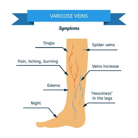 69777789_S-spider_veins_vericose_poor_circulation_clots_leg_foot.jpg