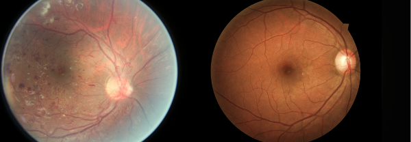 (Left) Image of a high risk candidate as identified by the ConvNet. (Right) Image of a low risk candidate.