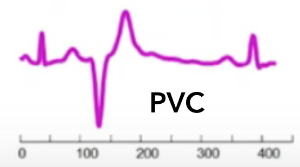 Figure 4. Template PVC wave used by the DTW algorithm.
