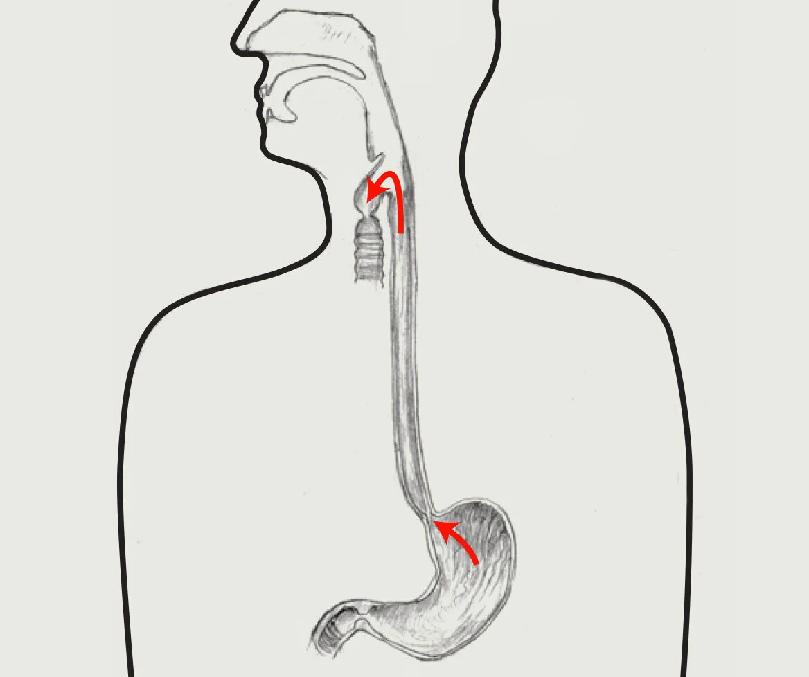 Laryngopharyngeal LPR Reflux Treatment True Voice Speech Pathology