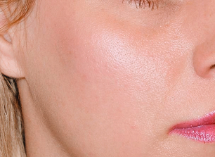 Cheek augmentation after.jpg