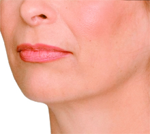 Jaw line and Prejowl after.jpg