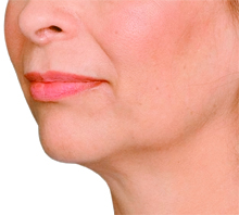 Jaw line and Prejowl before.jpg