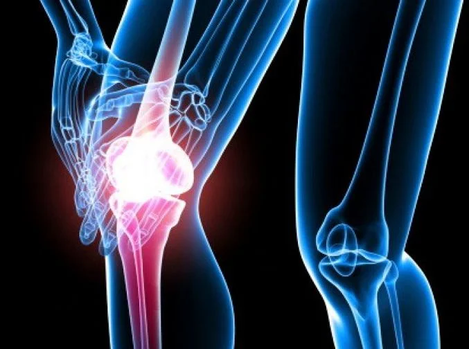 ARTHRITIS
